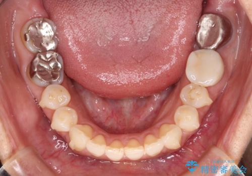 痛む奥歯と矯正の後戻り インビザライン・ライトとセラミック治療の治療中