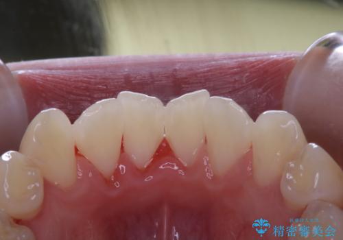 口臭が気になるためPMTCで予防の症例 治療後