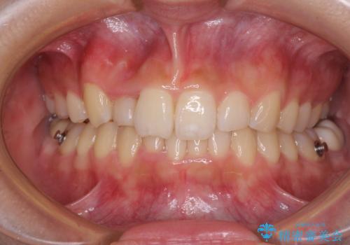 気になる八重歯を改善 補助装置併用のインビザライン治療の治療中