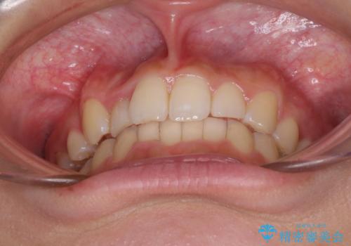 気になる八重歯を改善 補助装置併用のインビザライン治療の治療中