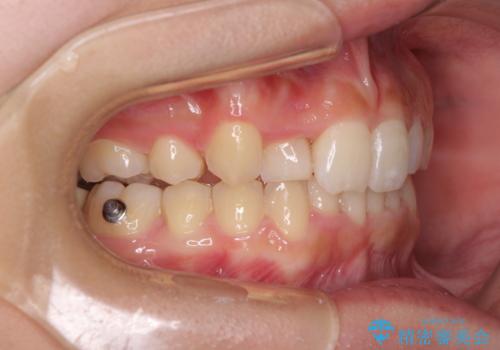 気になる八重歯を改善 補助装置併用のインビザライン治療の治療中