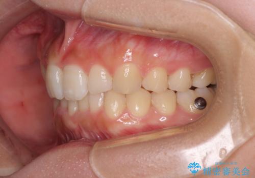 気になる八重歯を改善 補助装置併用のインビザライン治療の治療中
