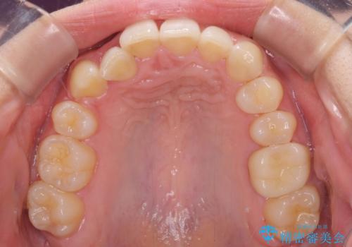 気になる八重歯を改善　補助装置併用のインビザライン治療の治療中