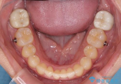 気になる八重歯を改善 補助装置併用のインビザライン治療の治療中