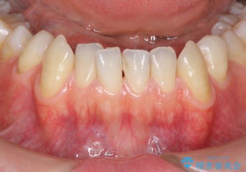 歯茎の下がりが気になる 歯肉移植でさがりにくくするの治療前