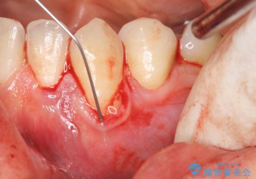 歯茎の下がりが気になる　歯肉移植でさがりにくくするの治療中