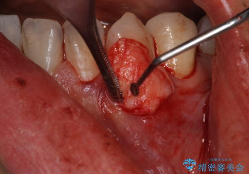 歯茎の下がりが気になる 歯肉移植でさがりにくくするの治療中