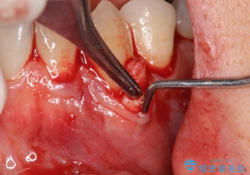 歯茎の下がりが気になる 歯肉移植でさがりにくくするの治療中