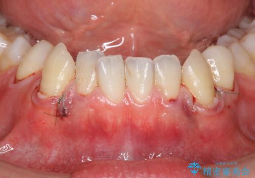 歯茎の下がりが気になる　歯肉移植でさがりにくくするの治療中