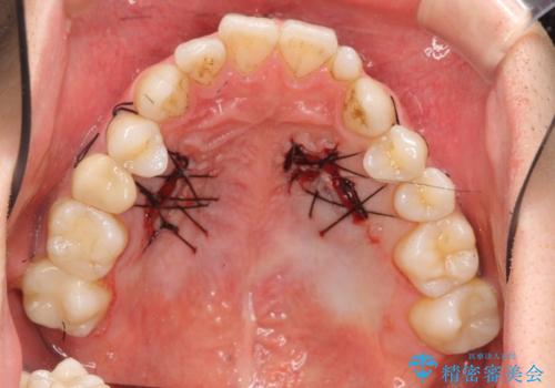 歯茎の下がりが気になる 歯肉移植でさがりにくくするの治療中