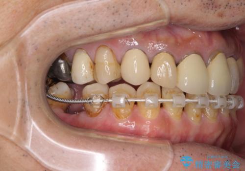 下顎の部分矯正を行ってから奥歯の補綴治療とインプラント治療の治療中