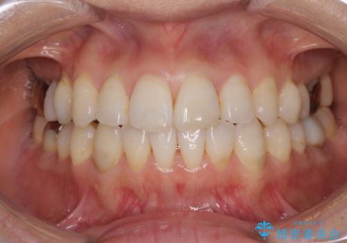 気になる前歯をインビザライン・ライトで 矯正治療後には銀歯をセラミックにの治療中