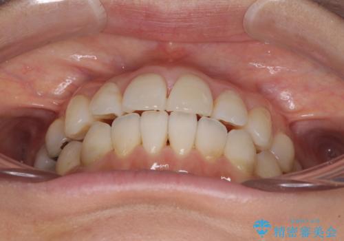 気になる前歯をインビザライン・ライトで 矯正治療後には銀歯をセラミックにの治療中