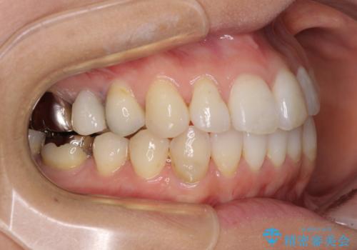 気になる前歯をインビザライン・ライトで　矯正治療後には銀歯をセラミックにの治療中