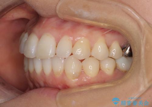 気になる前歯をインビザライン・ライトで 矯正治療後には銀歯をセラミックにの治療中