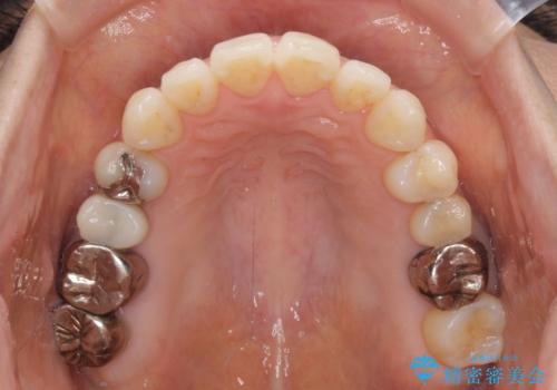 気になる前歯をインビザライン・ライトで 矯正治療後には銀歯をセラミックにの治療中