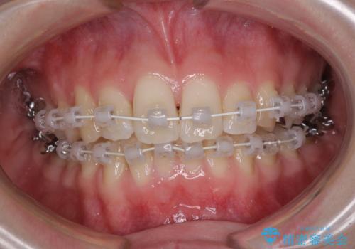 短期間での治療 急速拡大装置を併用したワイヤー装置による矯正治療の治療中