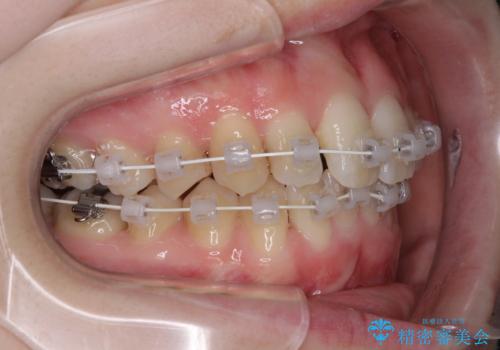 短期間での治療 急速拡大装置を併用したワイヤー装置による矯正治療の治療中