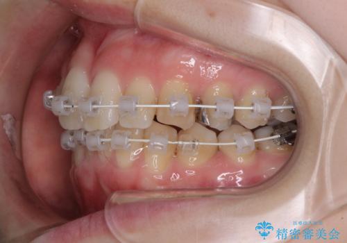 短期間での治療 急速拡大装置を併用したワイヤー装置による矯正治療の治療中