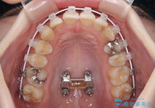 短期間での治療 急速拡大装置を併用したワイヤー装置による矯正治療の治療中