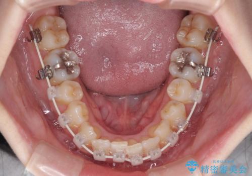 短期間での治療 急速拡大装置を併用したワイヤー装置による矯正治療の治療中