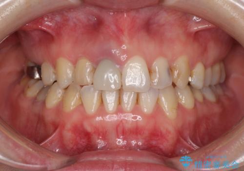 前歯のクロスバイトと治療が必要なむし歯　矯正とセラミックの総合歯科治療の治療中