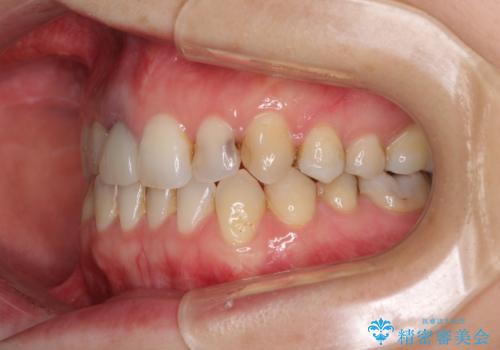 前歯のクロスバイトと治療が必要なむし歯 矯正とセラミックの総合歯科治療の治療中