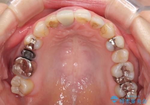 前歯のクロスバイトと治療が必要なむし歯 矯正とセラミックの総合歯科治療の治療中