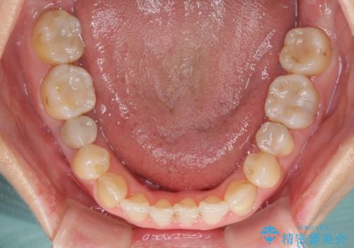 前歯のクロスバイトと治療が必要なむし歯 矯正とセラミックの総合歯科治療の治療中