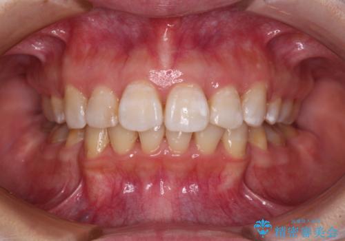 飛び出した前歯を引っ込めたい 目立たないワイヤーでの抜歯矯正の症例 治療後