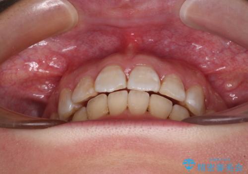 飛び出した前歯を引っ込めたい 目立たないワイヤーでの抜歯矯正の治療後