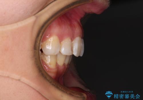 飛び出した前歯を引っ込めたい 目立たないワイヤーでの抜歯矯正の治療後