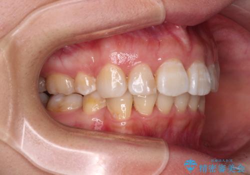 飛び出した前歯を引っ込めたい 目立たないワイヤーでの抜歯矯正の治療後