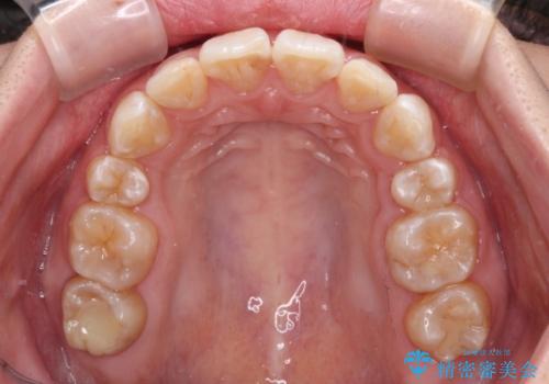 飛び出した前歯を引っ込めたい 目立たないワイヤーでの抜歯矯正の治療後
