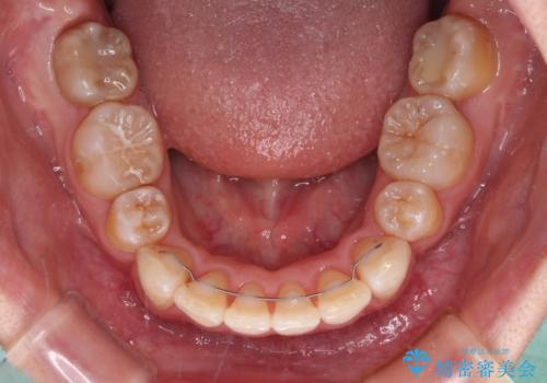 飛び出した前歯を引っ込めたい 目立たないワイヤーでの抜歯矯正の治療後