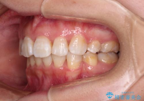 飛び出した前歯を引っ込めたい 目立たないワイヤーでの抜歯矯正の治療後