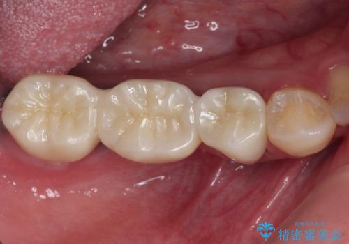 痛む奥歯　目立つ銀色の奥歯をセラミックに　セラミックブリッジの症例 治療後