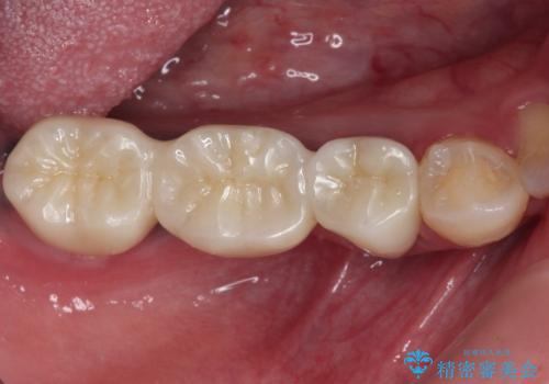 痛む奥歯　目立つ銀色の奥歯をセラミックに　セラミックブリッジの治療後