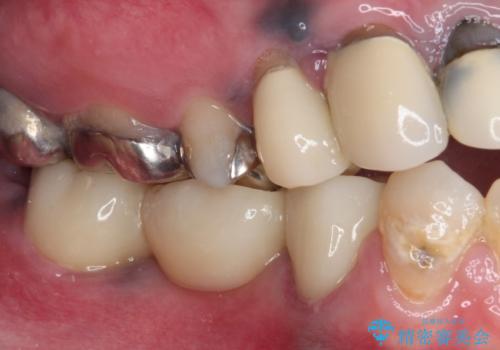 痛む奥歯 目立つ銀色の奥歯をセラミックに セラミックブリッジの治療後