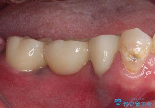 痛む奥歯 目立つ銀色の奥歯をセラミックに セラミックブリッジの治療後