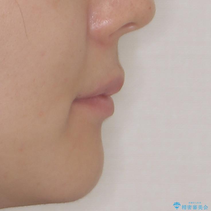 飛び出した前歯を引っ込めたい 目立たないワイヤーでの抜歯矯正の治療後(顔貌)