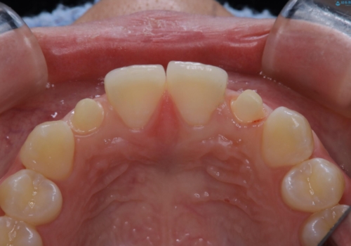 部分矯正とセラミッククラウンですきっ歯・矮小歯を効率的に治すの治療中
