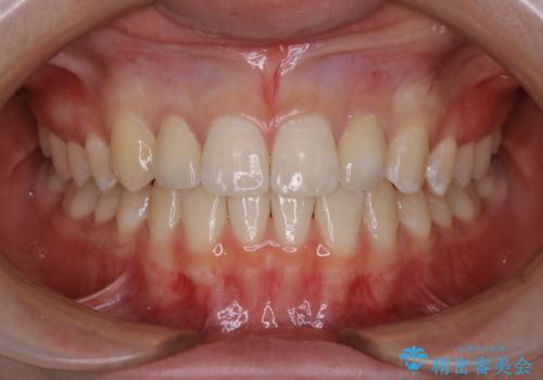 部分矯正とセラミッククラウンですきっ歯・矮小歯を効率的に治すの症例 治療後
