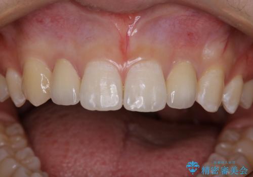 部分矯正とセラミッククラウンですきっ歯・矮小歯を効率的に治すの治療後