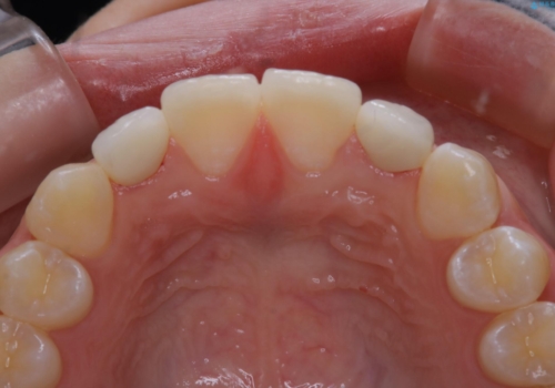 部分矯正とセラミッククラウンですきっ歯・矮小歯を効率的に治すの治療後