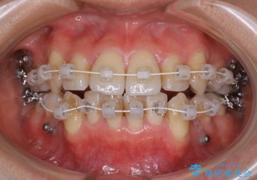 八重歯がスッキリ 抜歯ワイヤー矯正の治療中