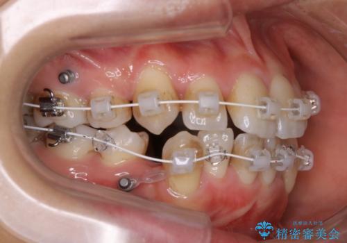 八重歯がスッキリ 抜歯ワイヤー矯正の治療中
