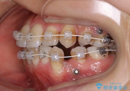 八重歯がスッキリ 抜歯ワイヤー矯正の治療中