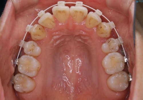 八重歯がスッキリ 抜歯ワイヤー矯正の治療中
