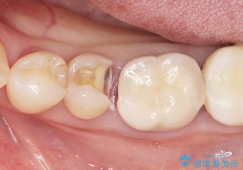 詰め物の境目が黒くて気になる 40代女性の治療中